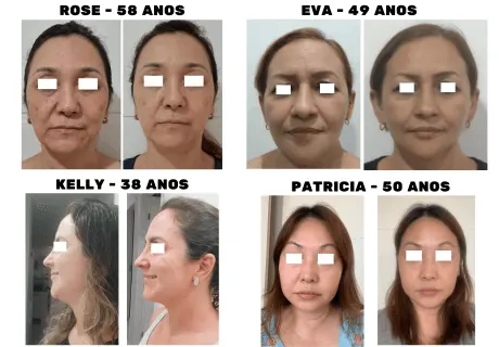 Resultados reais de alunas que seguiram os exercícios do método Personal Face