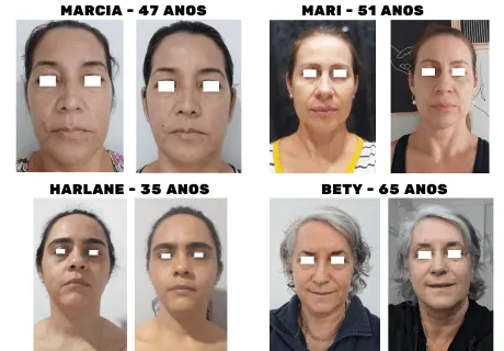 Mais resultados reais de alunas que seguiram os exercícios do método Personal Face